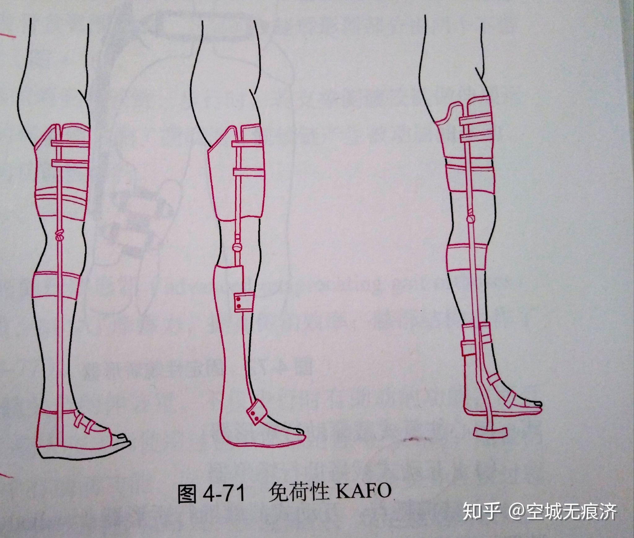 臨床康復(fù)工程學(xué) 假肢與矯形器的功能、設(shè)計(jì)與發(fā)展